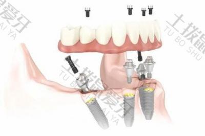 种植牙科普：种植牙的使用寿命受哪些因素影响？