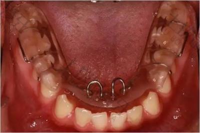 正畸科普：成人牙齿矫正后的保持器使用方法