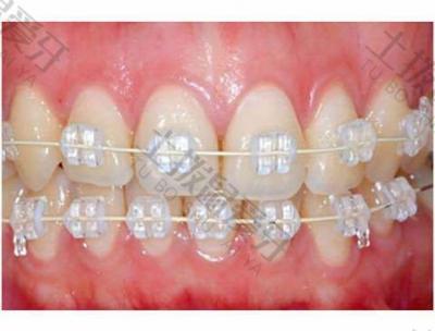 牙齿矫正会失败吗？哪些方法可以提高牙齿矫正的效果？