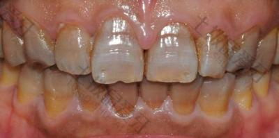 氟斑牙和龋齿的区别是什么？氟斑牙要怎么治疗？