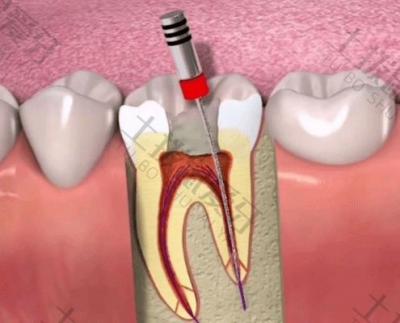 牙髓坏死有哪些症状？牙髓坏死需要进行根管治疗吗？