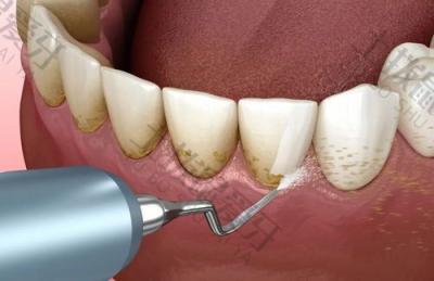 洁牙会使牙缝变大吗？洗牙后应该如何进行护理？