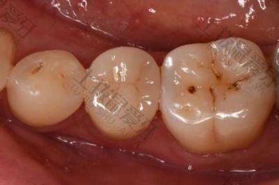 牙科小知识：窝沟封闭对预防儿童蛀牙有哪些好处？