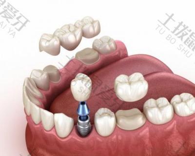 牙周炎对种植牙手术会有影响吗？种植牙术前需要考虑什么？