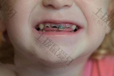 儿童龋齿的预防方法有哪些？儿童龋齿需要补牙吗？