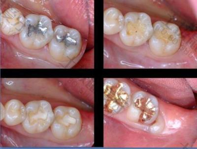 牙科小知识：牙齿龋坏后不拔牙还有哪些治疗方法？