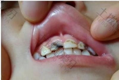 儿童龋齿的早期症状有哪些？儿童龋齿治疗要趁早吗？
