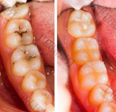 牙齿龋坏后会有哪些后果？怎么判断牙齿的龋坏是否到达牙髓？