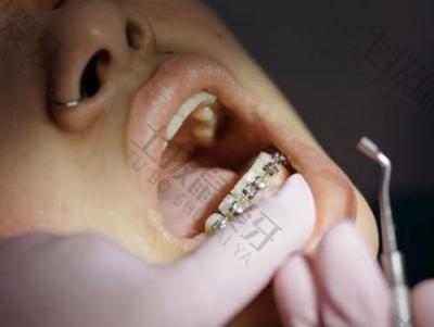 矫正牙齿对颧骨有影响吗？矫正过程中牙齿酸痛正常吗？
