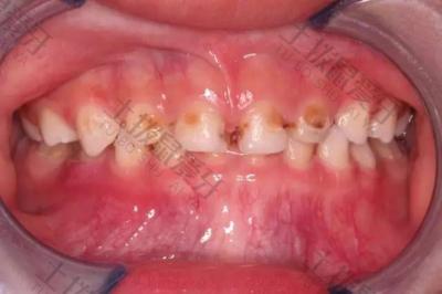 哪些人更容易患龋齿和牙龈炎？要怎么预防？