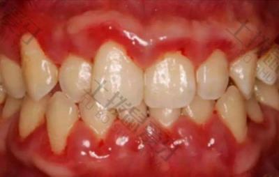 如何有效预防龋齿？牙龈炎的症状有哪些？