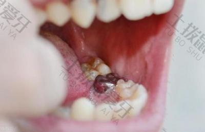 龋齿治疗后容易复发吗？要怎么避免龋齿治疗后的复发？