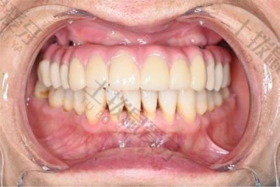 种植牙小知识：怎么样可以确保种植牙的耐用性？