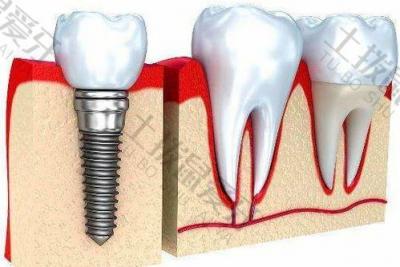 种牙小知识：在种植牙的维护过程中需要注意哪些方面？