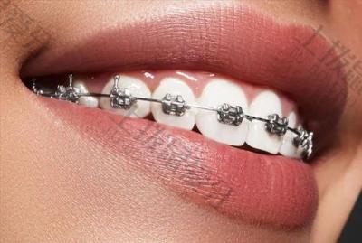 牙根吸收有什么症状？牙根吸收会影响矫正效果吗？