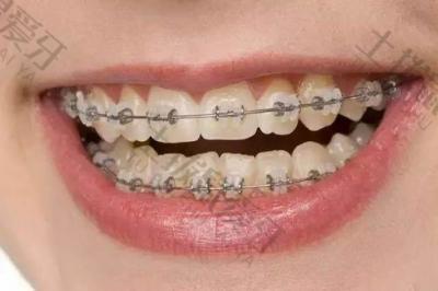 正畸小知识：如何降低种植钉在牙齿矫正中使用的风险？