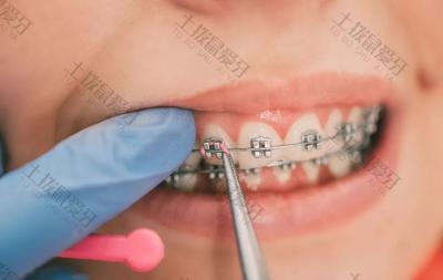 牙齿不齐危害大不大？为什么越来越多人做牙齿矫正？