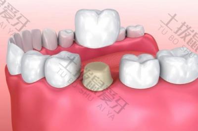 镶牙的价格受哪些因素影响？镶牙后需要注意些什么？