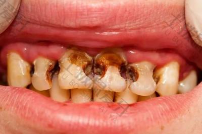 牙齿龋齿一定会痛吗？龋齿何时就诊比较好？