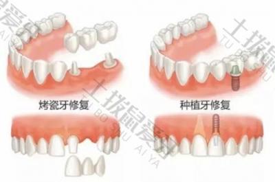 牙科知识：老年人牙齿缺失多年要怎么选择修复方式？