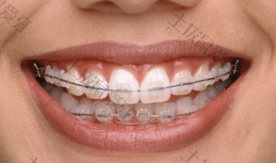牙齿矫正后为什么会牙齿前倾？要怎么处理？