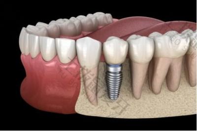 种牙小知识：种植牙质保服务不涵盖的种植牙失败情况有哪些？
